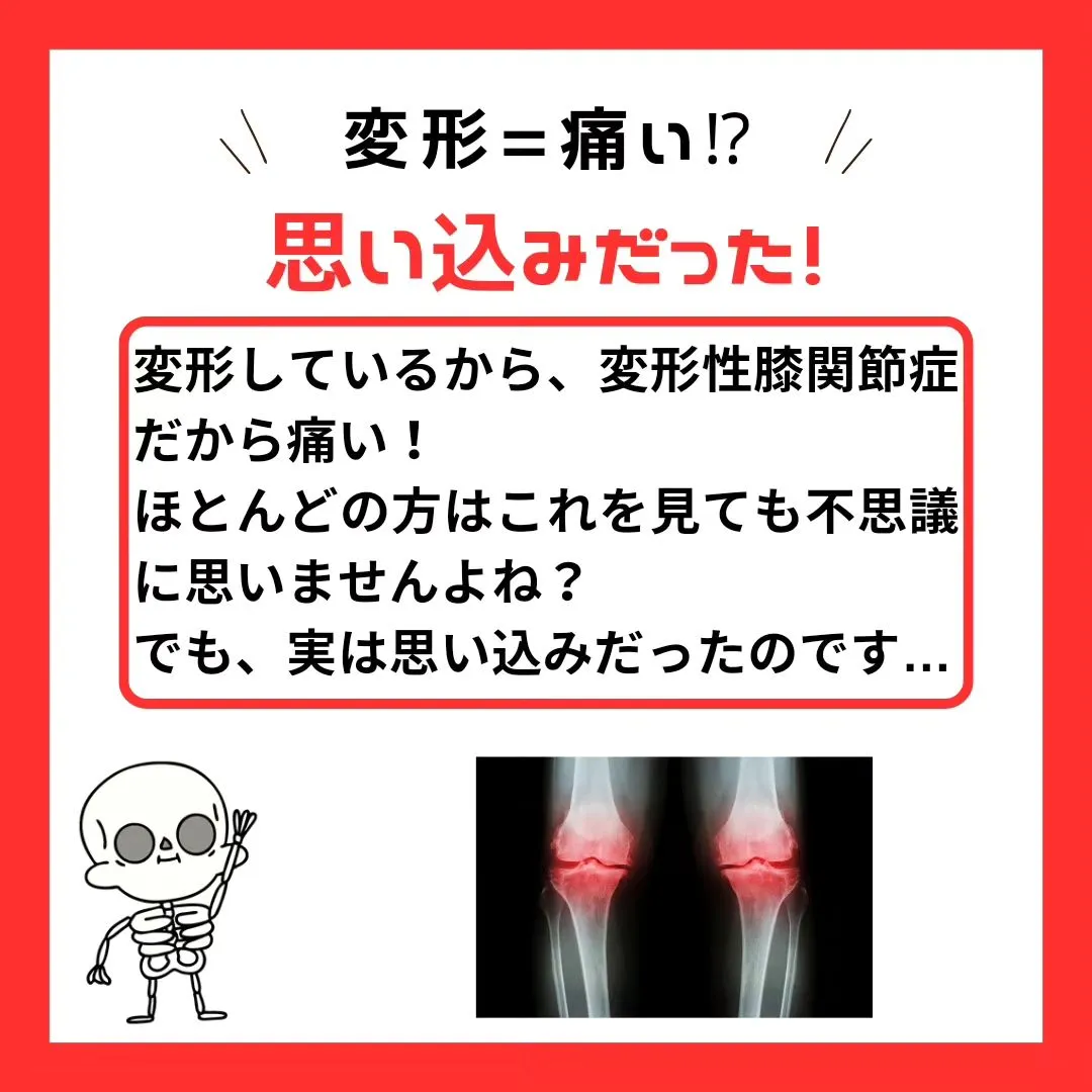 【膝の痛み】変形性膝関節症、変形しているから痛い！これは嘘だ...